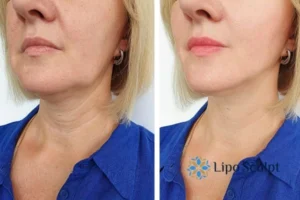 Double chin before and after Hi-Fu treatment 4 Book your double chin treatment Norfolk today! We are here to help!