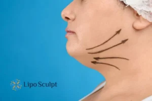 Double chin before and after Hi-Fu treatment 3 Boost your confidence with a Double chin treatment Norfolk