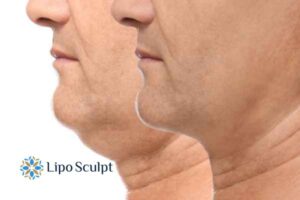 Double chin before and after Hi-Fu treatment 2 Double chin treatment Norfolk from Lipo Sculpt - feel more confident today!