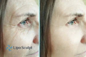 How to Fight Aging Symptoms 2 Do you want to Fight Aging Symptoms Norfolk? Contact Lipo Sculpt today!