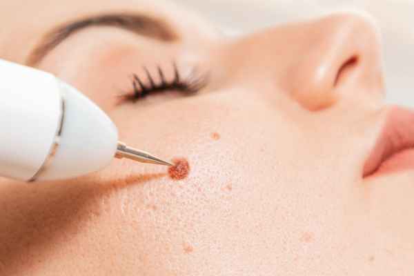 CryoPen: 5 Skin Concerns It May Be Used to Treat 3 What actually happens during a CryoPen treatment Norfolk?