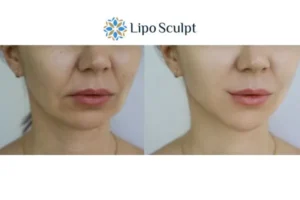 Explaining Total Skin Tightening Treatment And What It Can Do For You 2 Do you want to boost your self confidence? Give Morpheus8 Norfolk a try today!