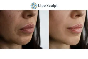 Explaining Total Skin Tightening Treatment And What It Can Do For You 4 Morpheus8 Norfolk the best results - call our team today!
