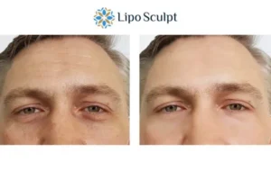 Explaining Total Skin Tightening Treatment And What It Can Do For You 6 Morpheus8 Norfolk book in today to find out more!