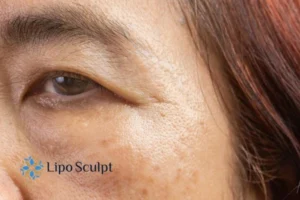Cryopen: The Revolutionary Treatment for Age Spots Unveiled 2 Are age spots Norfolk giving you low self esteem? Contact us today!
