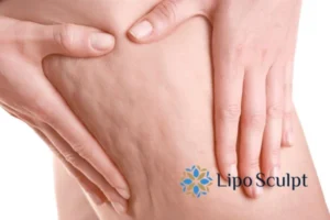 CoolSculpting for Legs: The Innovative Approach to Redefining Your Legs 5 Start your journey today book your coolsculpting treatment Norfolk online today!