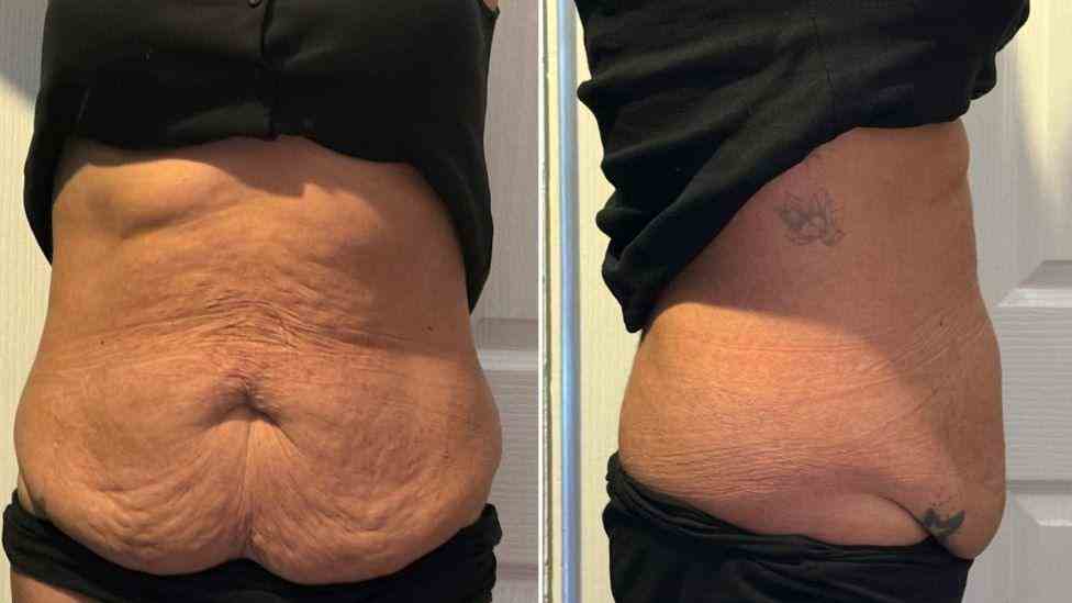 Lost the Weight but Not the Loose Skin? What You Should Know 1 Is It Definitely Loose Skin Norfolk?