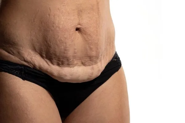 Lost the Weight but Not the Loose Skin? 1 image of womans stomach after weight loss showing loose skin Norfolk